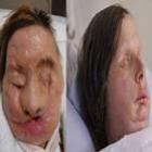 Nova face de mulher desfigurada após ataque de chimpanzé é revelada