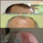 queda_de_cabelo_a_calvicie_pode_ser_solucionada