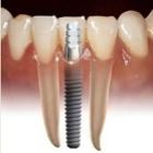 Implante Dentário: Veja como são os procedimentos!