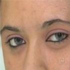 Médico desenvolve técnica para mudar a cor dos olhos