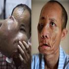 chines_tem_tumor_do_tamanho_de_bola_de_futebol_retirado_do_rosto