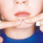como_prevenir_cicatrizes_causadas_pela_acne
