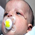 Pele retirada em circuncisão salva visão de bebê que nasceu sem pálpebras em Isr
