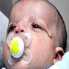 pele_retirada_em_circuncisao_salva_visao_de_bebe_que_nasceu_sem_palpebras_em_isr