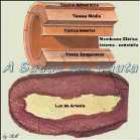 arteriosclerose_deterioracao_das_arterias