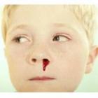 Por que ocorre o sangramento pelo nariz?