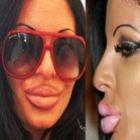 desastres_em_cirurgias_plasticas_unem_famosos_e_anonimos