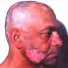 lupus__a_doenca_da_defesa_do_mal