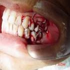 Veja como recuperar os dentes após acidentes!