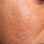 tratamento_caseiros_para_melhorar_a_aparecia_das_cicatrizes_de_acne