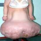 sindrome_de_proteus