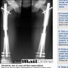 _britanico_gasta_r$_822_mil_em_cirurgia_para_ficar_mais_alto