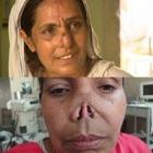 Mulher atacada por marido diz ter nascido de novo com reconstrução de nariz