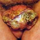 entenda_como_o_hpv_age_dentro_do_organismo
