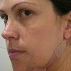 lipo_de_mento__cirurgia