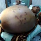 tumor_gigante_e_como_se_ela_carregasse_10_bebes_de_4_kg_cada