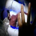 bebe_sobrevive_nos_estados_unidos_apos_nascer_com_apenas_270_gramas