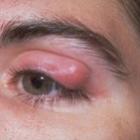 tercol_patologia_infecciosa_dos_olhos