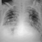 pneumonia_aspirativa_do_idoso