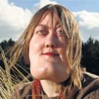 doenca_querubismo_conheca_victoria_wright