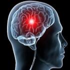 acidente_vascular_cerebral__causas_sintomas_e_prevencao