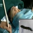 medicos_retiram_sanguessuga_viva_da_traqueia_de_chines_de_16_anos