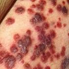sarcoma_de_kaposi_doenca_terrivel