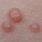 Infecção de pele muito comum em crianças causada por molusco