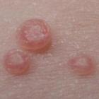 infeccao_de_pele_muito_comum_em_criancas_causada_por_molusco