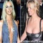 Celebridades antes e depois do silicone