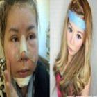 _mulher_gasta_r$_230_mil_com_cirurgias_e_fica_com_rosto_de_plastico
