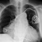 emocionante_homem_com_dois_coracoes_sobrevive_a_duplo_ataque_cardiaco