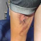 fiquei_com_trauma_diz_gravida_queimada_durante_parto_em_mt