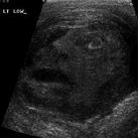 ultrassom_mostra_face_em_tumor_testicular