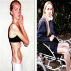 _britanica_consegue_se_recuperar_de_anorexia_nervosa