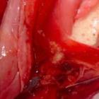 o_que_e_edema_pulmonar