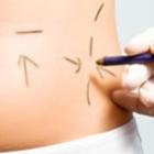 lipoaspiracao_nao_combinada_com_exercicios_pode_ser_danosa