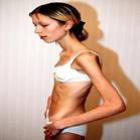 Mulher morre após 16 anos de batalha contra a anorexia nervosa ...