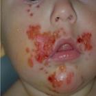 impetigo_doenca_altamente_contagiosa_