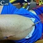 atleta_tem_coxa_perfurada_por_pedaco_de_madeira_durante_jogo