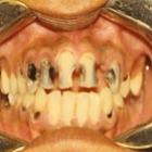sera_que_as_caries_sao_contagiosas