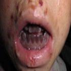 _crianca_e_diagnosticada_com_&lsquo;sindrome_do_vampiro&rsquo;_no_vietna_