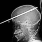 Garoto atira acidentalmente contra sua cabeça com arma de arpão nos EUA