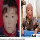 chines_de_5_anos_ganha_cirurgia_para_reconstruir_o_rosto_queimado
