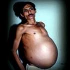 indiano_com_dor_abdominal_descobre_ser_hemafrodita