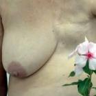 mulher_de_99_anos_faz_operacao_para_retirada_de_tumor_no_seio_no_reino_unido