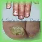 onicomicose_micose_nas_unhas