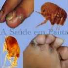 tungiase_quem_ja_teve_&ldquo;bicho_de_pe&rdquo;