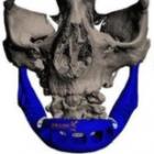 mulher_recebe_protese_de_mandibula_fabricada_por_impressora_3d_