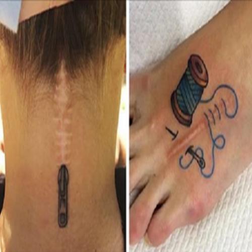 11 pessoas que aproveitaram suas cicatrizes para fazer tatuagens...